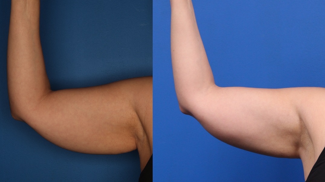 CoolSculpting Before & After Gallery - Patient 266954 - Image 1