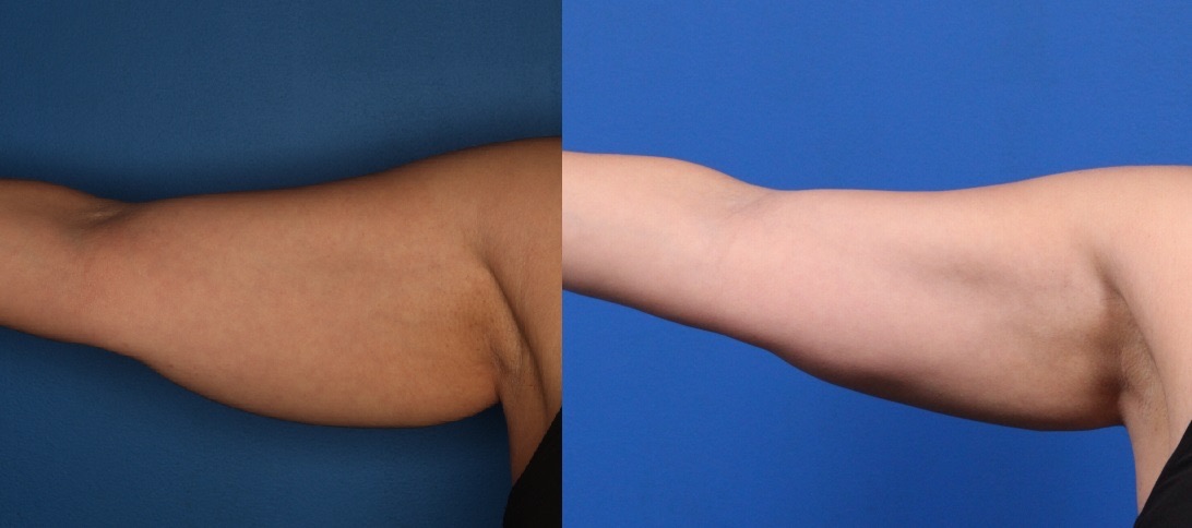 CoolSculpting Before & After Gallery - Patient 266954 - Image 2