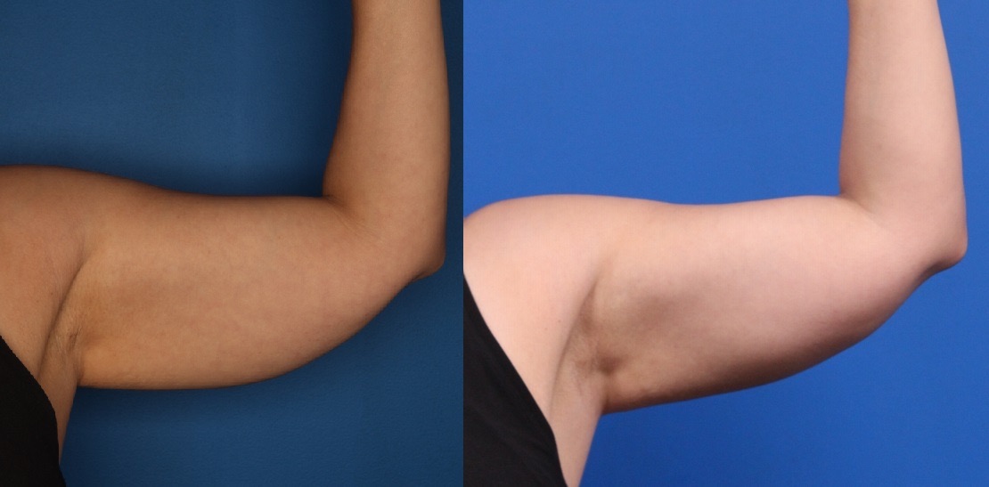 CoolSculpting Before & After Gallery - Patient 266954 - Image 3