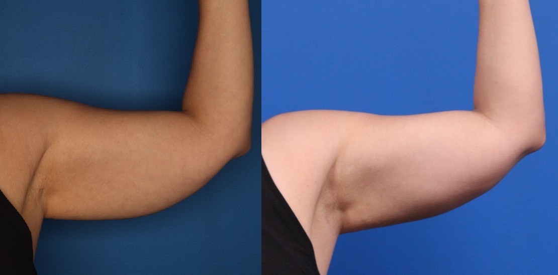 CoolSculpting Gallery Before & After Gallery - Patient 266954 - Image 3