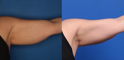 CoolSculpting Gallery Before & After Gallery - Patient 266954 - Image 4