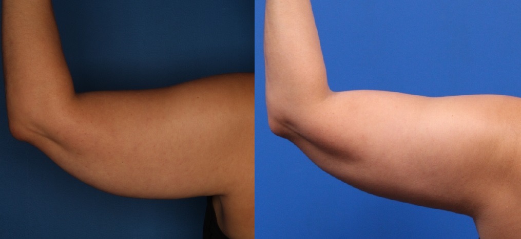 CoolSculpting Gallery Before & After Gallery - Patient 266954 - Image 5