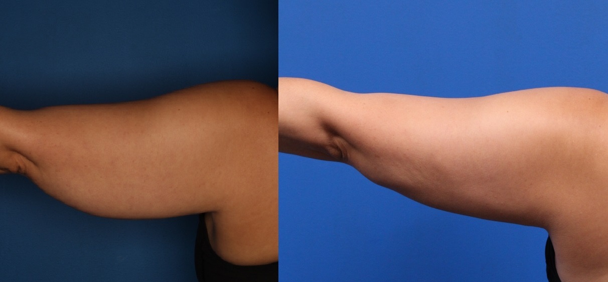 CoolSculpting Before & After Gallery - Patient 266954 - Image 6