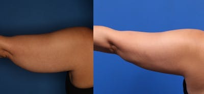 CoolSculpting Gallery Before & After Gallery - Patient 266954 - Image 6