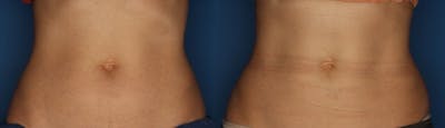 CoolSculpting Before & After Gallery - Patient 400738 - Image 1