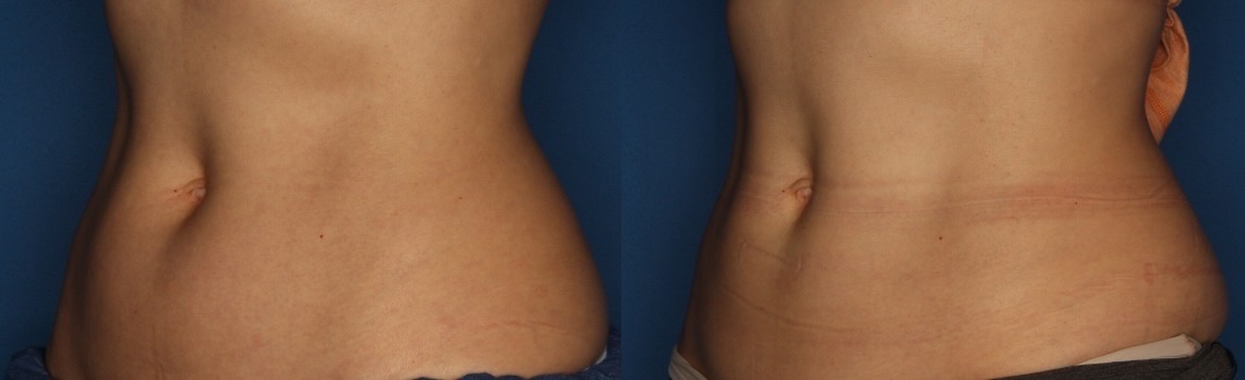 CoolSculpting Gallery Before & After Gallery - Patient 400738 - Image 2