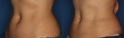 CoolSculpting Gallery Before & After Gallery - Patient 400738 - Image 2