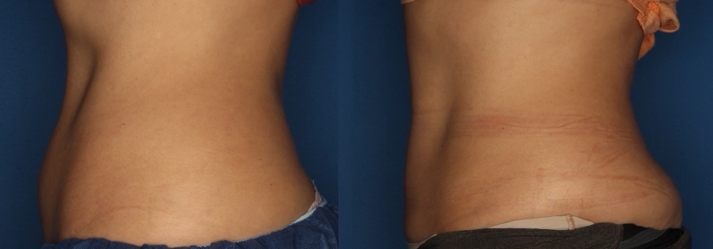 CoolSculpting Gallery Before & After Gallery - Patient 400738 - Image 3