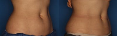 CoolSculpting Gallery Before & After Gallery - Patient 400738 - Image 4