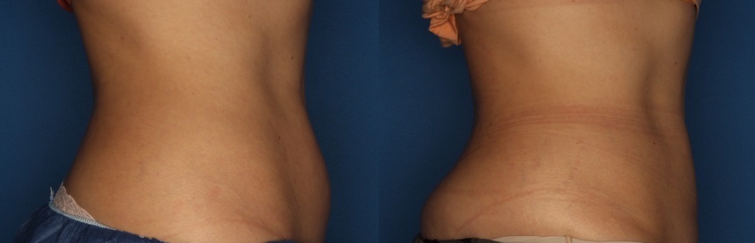 CoolSculpting Gallery Before & After Gallery - Patient 400738 - Image 5