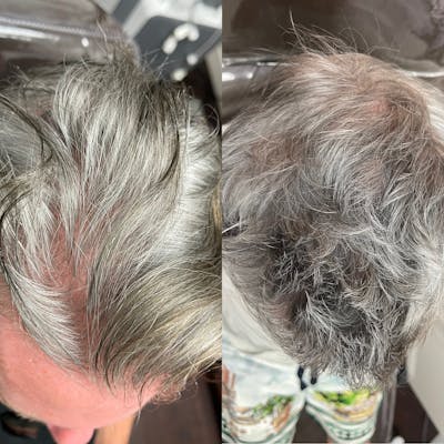 PRP Hair Loss Gallery Before & After Gallery - Patient 660605 - Image 1