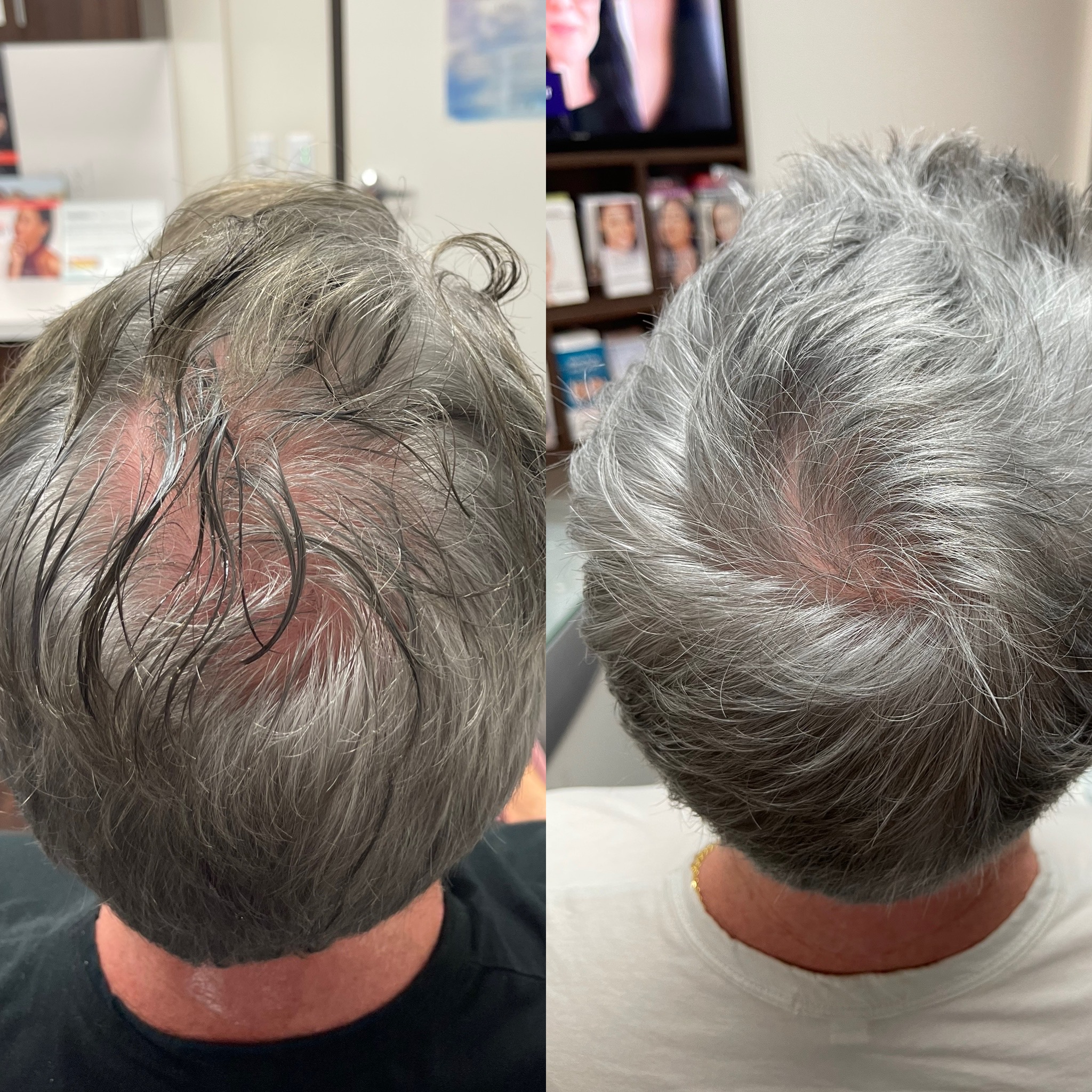 PRP Hair Loss Gallery Before & After Gallery - Patient 660605 - Image 3