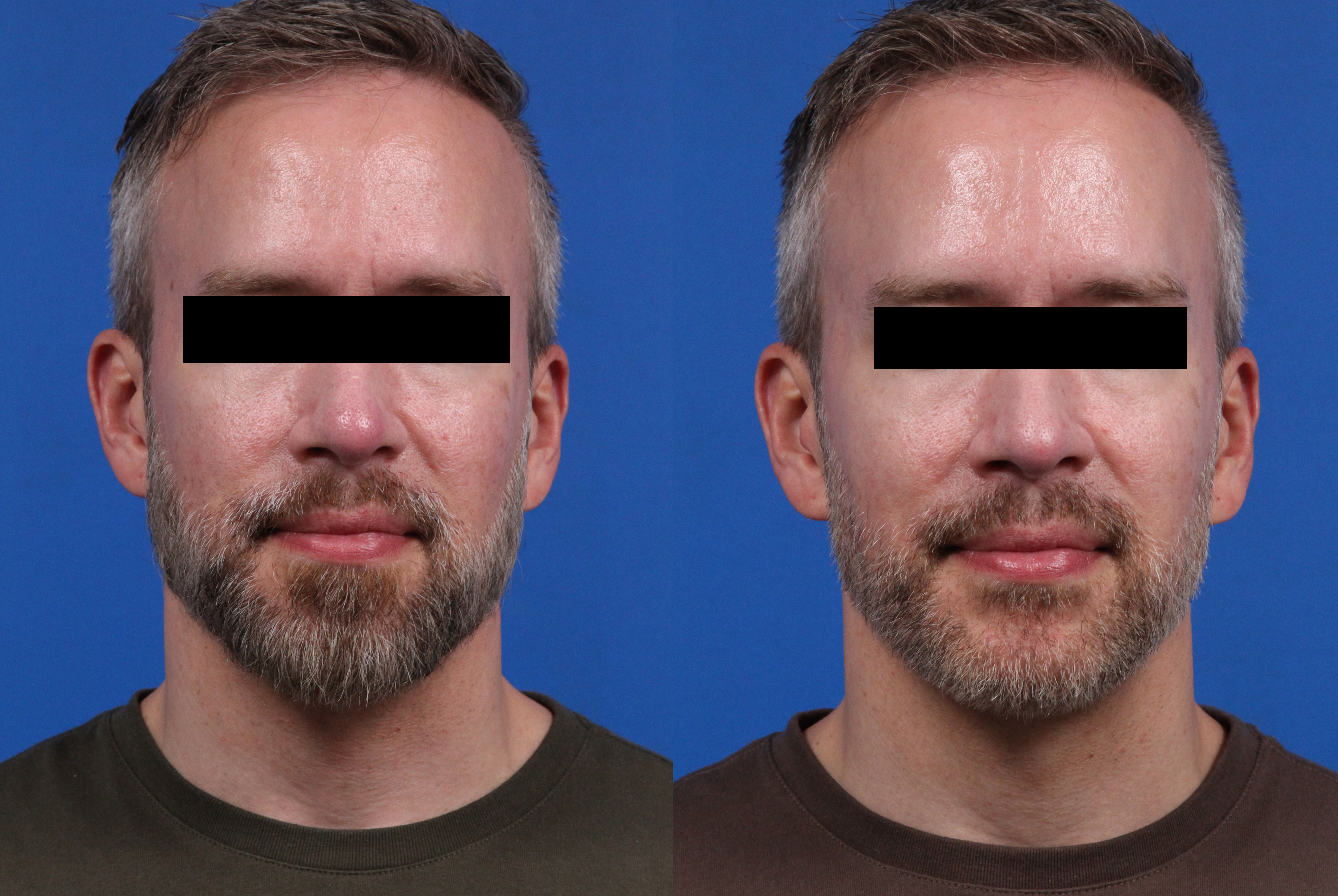 Excel V. Gallery Before & After Gallery - Patient 285063 - Image 1