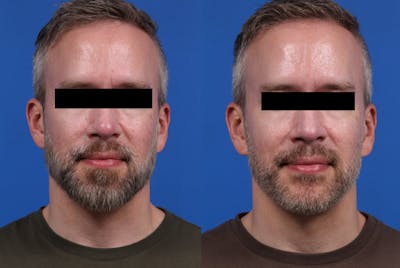 Excel V. Gallery Before & After Gallery - Patient 285063 - Image 1