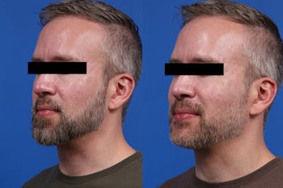 Excel V. Gallery Before & After Gallery - Patient 285063 - Image 2
