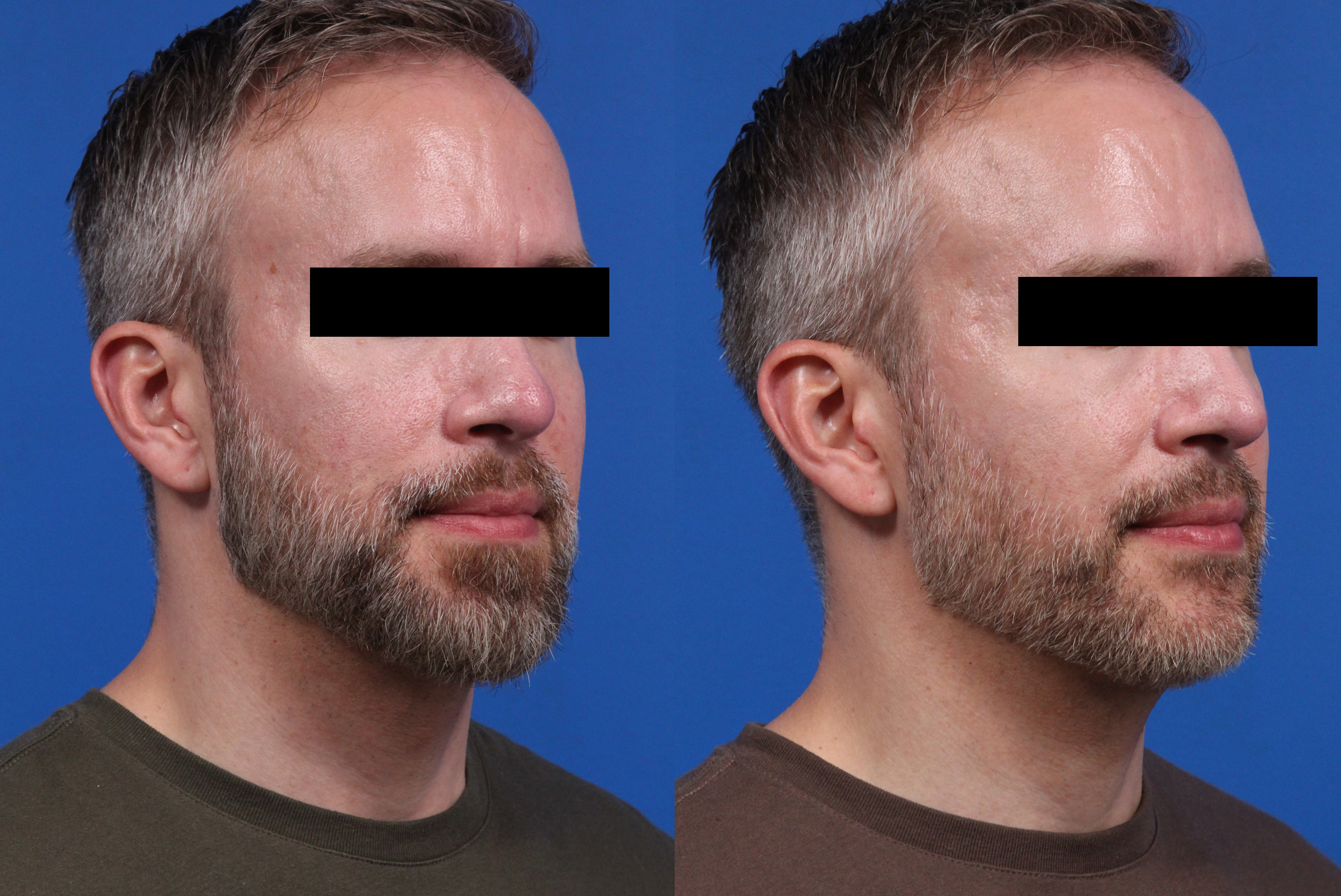 Excel V. Gallery Before & After Gallery - Patient 285063 - Image 3
