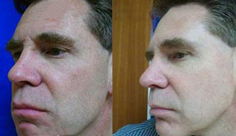 LaserFirm Gallery Before & After Gallery - Patient 24560547 - Image 1