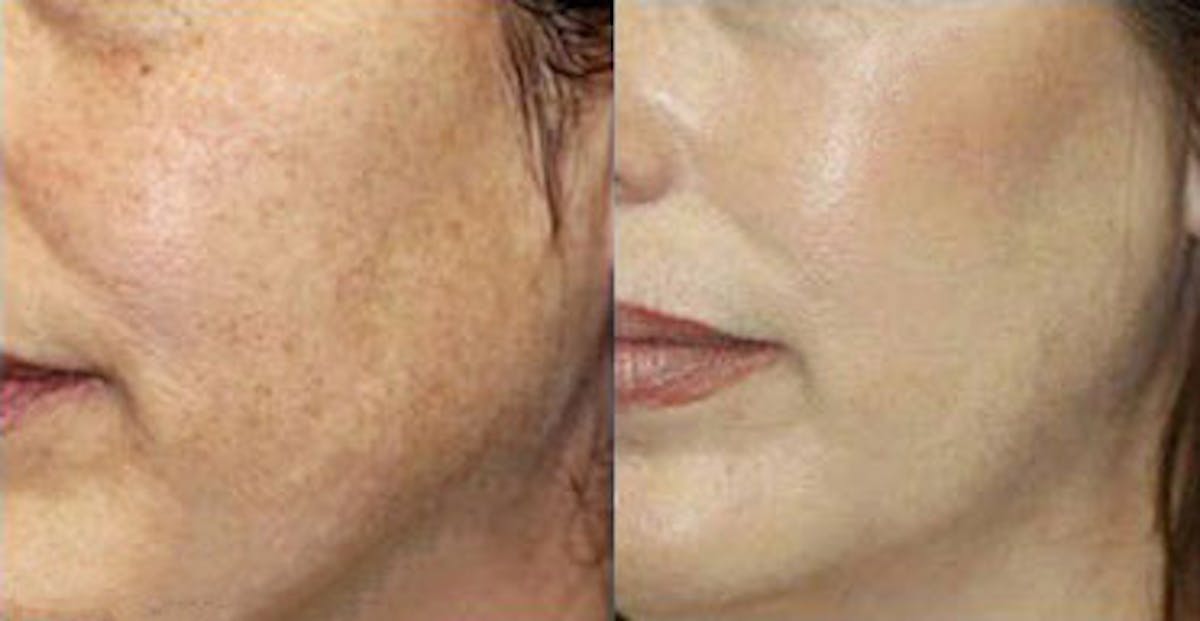 LaserFirm Gallery Before & After Gallery - Patient 24560549 - Image 1
