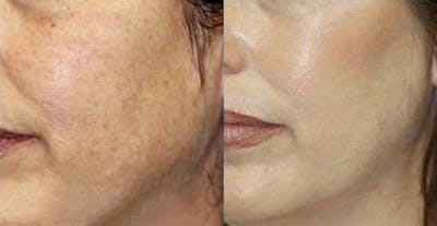 LaserFirm Gallery Before & After Gallery - Patient 24560549 - Image 1