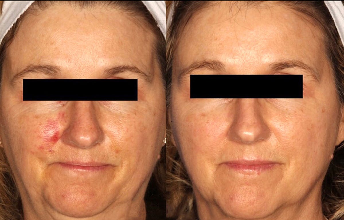 Excel V. Gallery Before & After Gallery - Patient 24560523 - Image 1