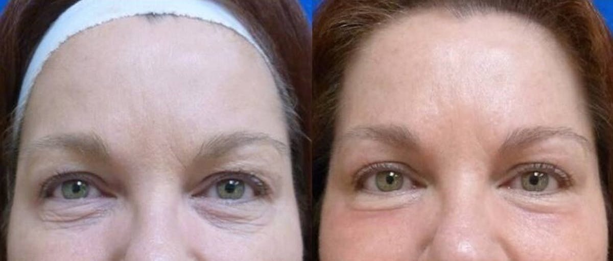 TotalFX Gallery Before & After Gallery - Patient 24560648 - Image 1