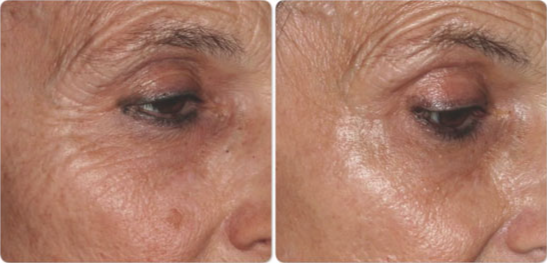 TotalFX Gallery Before & After Gallery - Patient 24560670 - Image 1