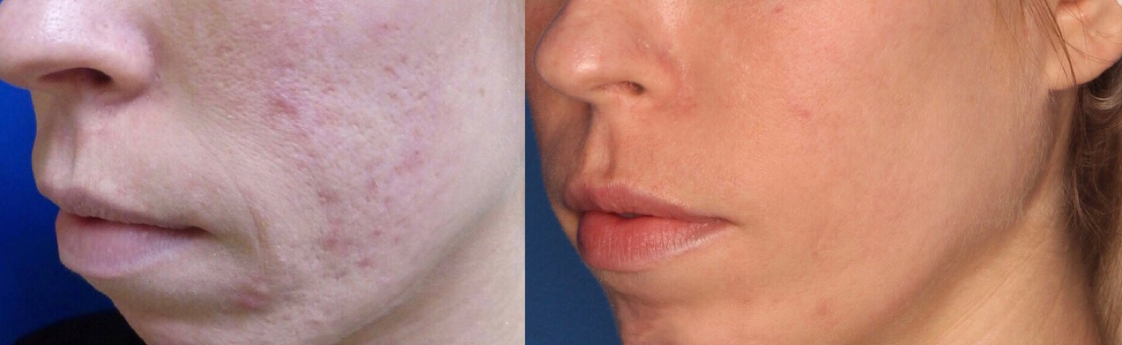 TotalFX Gallery Before & After Gallery - Patient 24560673 - Image 1