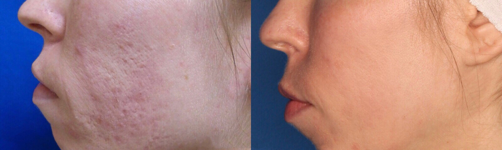 TotalFX Gallery Before & After Gallery - Patient 24560673 - Image 2