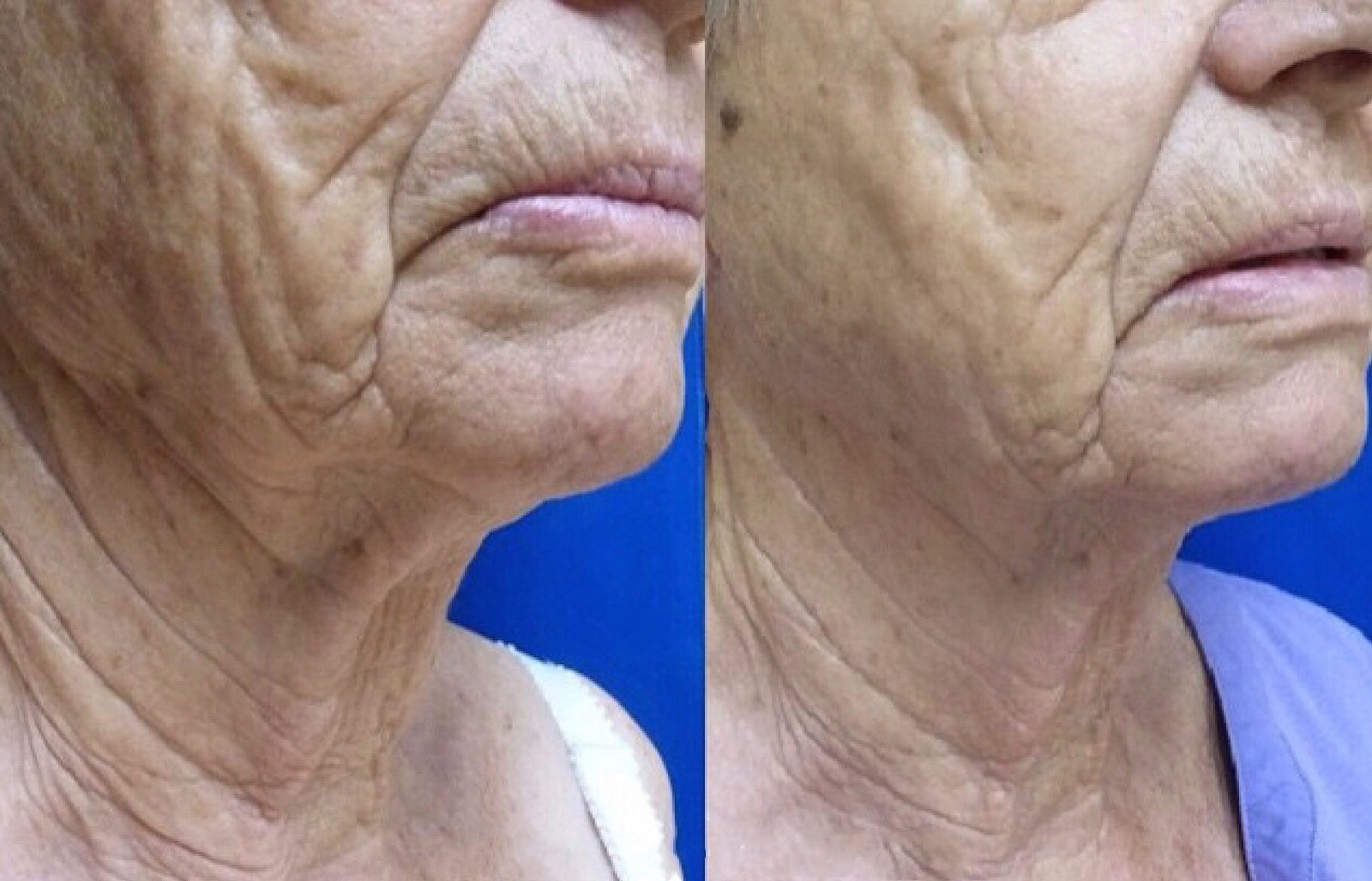 Ultherapy Gallery Before & After Gallery - Patient 24560671 - Image 3