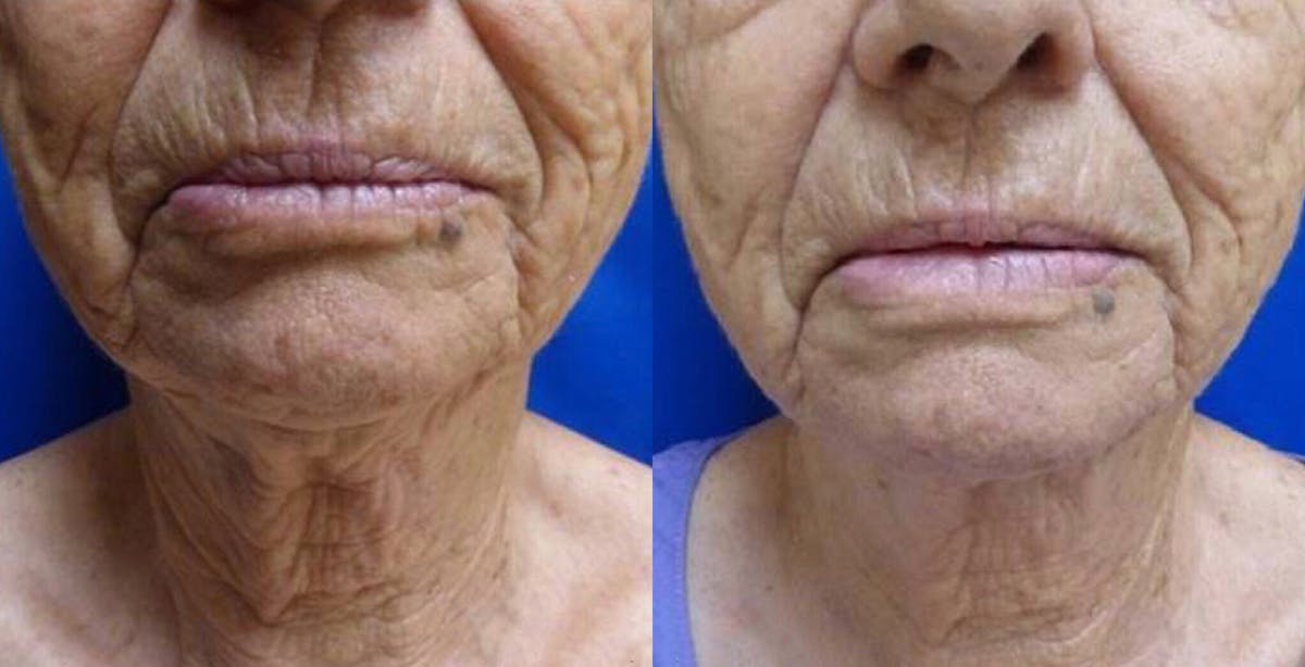 Ultherapy Gallery Before & After Gallery - Patient 24560671 - Image 1