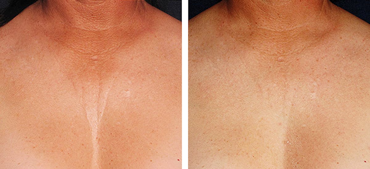 Ultherapy Gallery Before & After Gallery - Patient 36623110 - Image 1