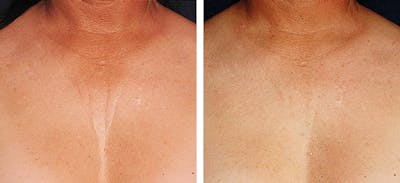 Ultherapy Gallery Before & After Gallery - Patient 36623110 - Image 1