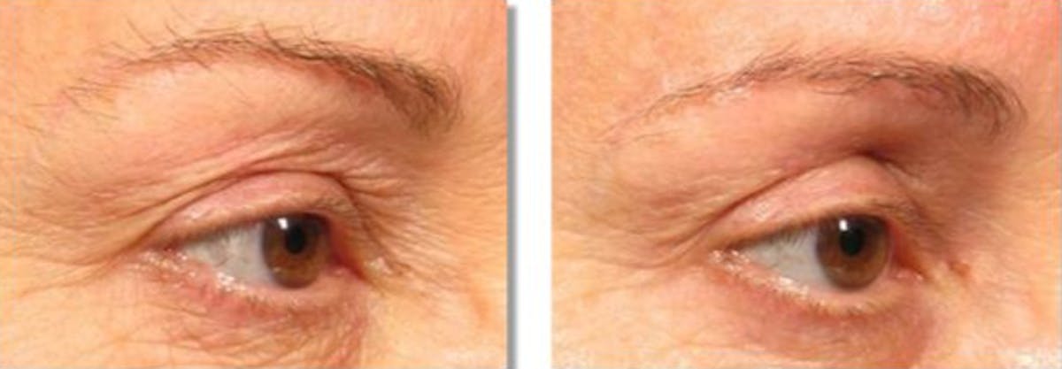 Ultherapy Gallery Before & After Gallery - Patient 36623111 - Image 1
