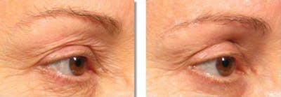 Ultherapy Gallery Before & After Gallery - Patient 36623111 - Image 1