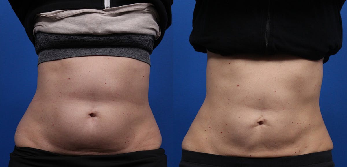 CoolSculpting Gallery Before & After Gallery - Patient 378527 - Image 1