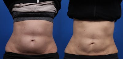CoolSculpting Gallery Before & After Gallery - Patient 378527 - Image 1