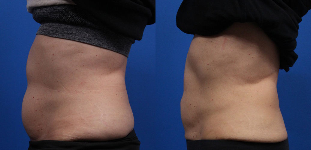 CoolSculpting Gallery Before & After Gallery - Patient 378527 - Image 7