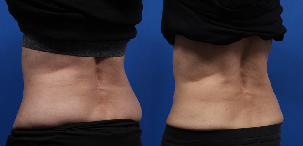 CoolSculpting Gallery Before & After Gallery - Patient 378527 - Image 6