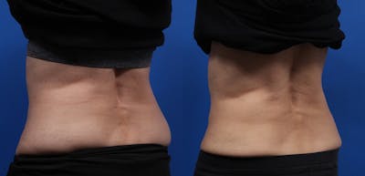 CoolSculpting Gallery Before & After Gallery - Patient 378527 - Image 6