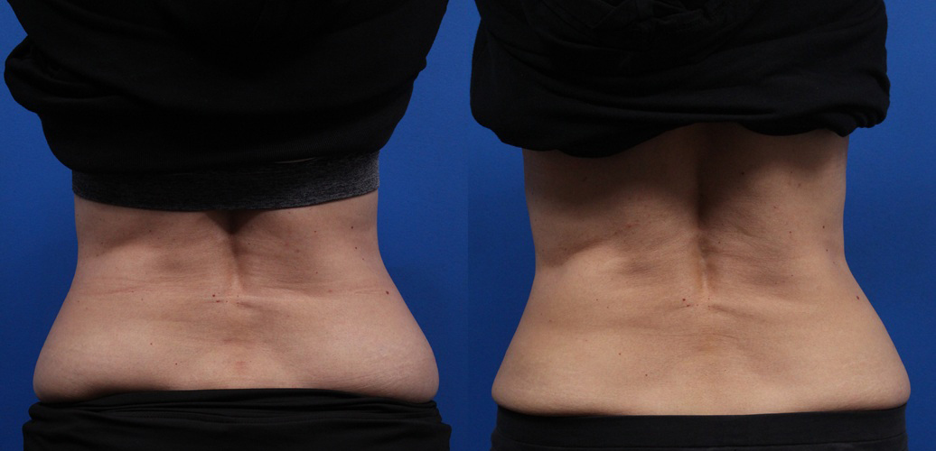 CoolSculpting Gallery Before & After Gallery - Patient 378527 - Image 5