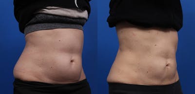 CoolSculpting Gallery Before & After Gallery - Patient 378527 - Image 2