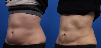 CoolSculpting Gallery Before & After Gallery - Patient 378527 - Image 8