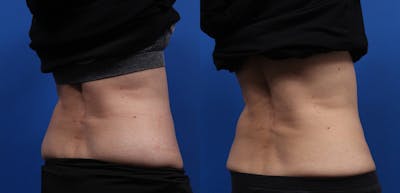 CoolSculpting Gallery Before & After Gallery - Patient 378527 - Image 4