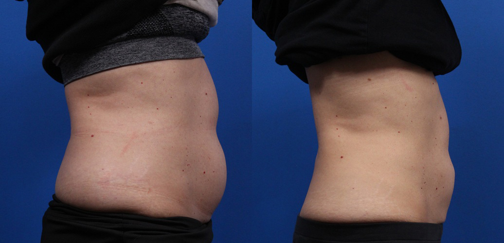 CoolSculpting Gallery Before & After Gallery - Patient 378527 - Image 3