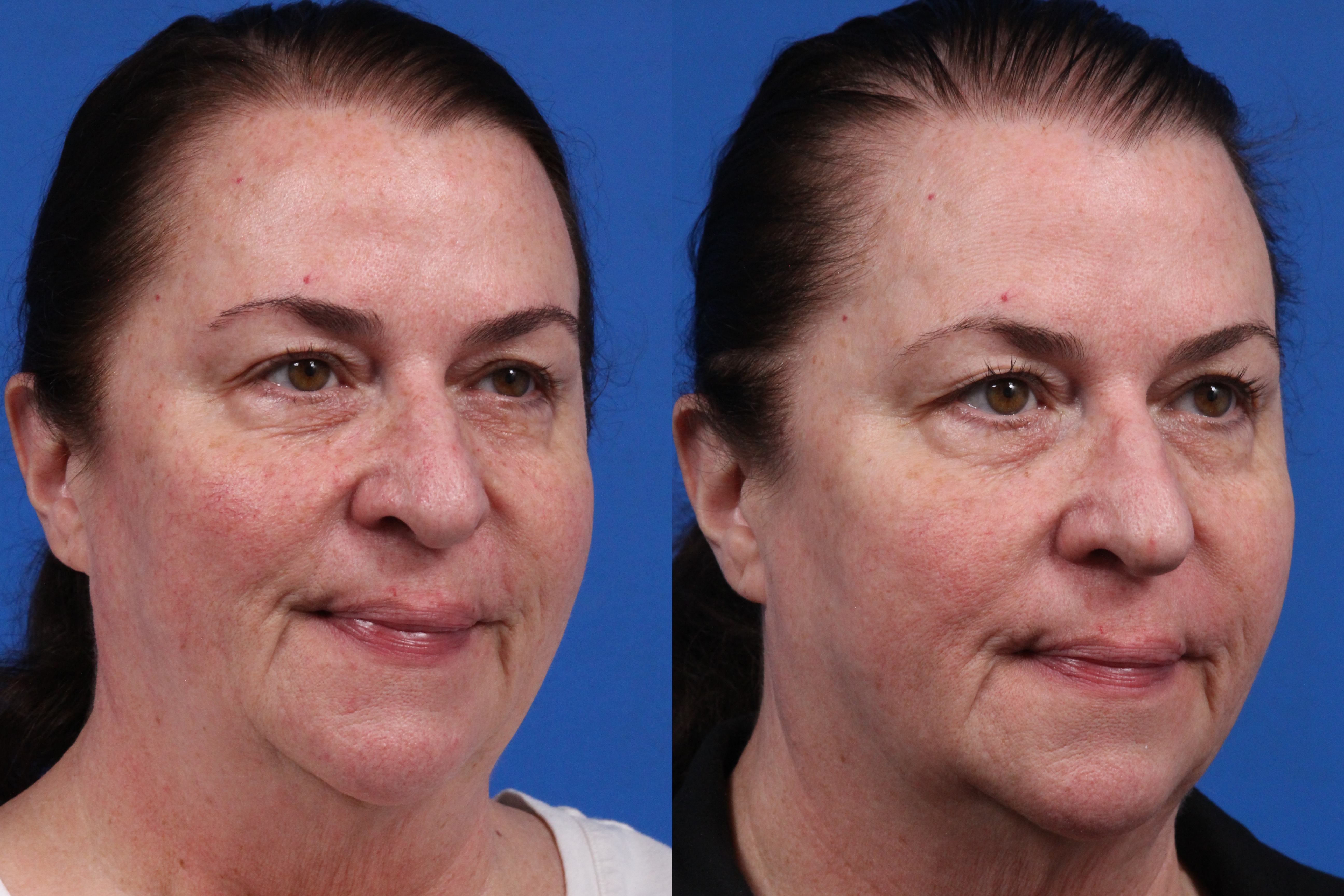 BBL Hero Gallery Before & After Gallery - Patient 209152 - Image 1