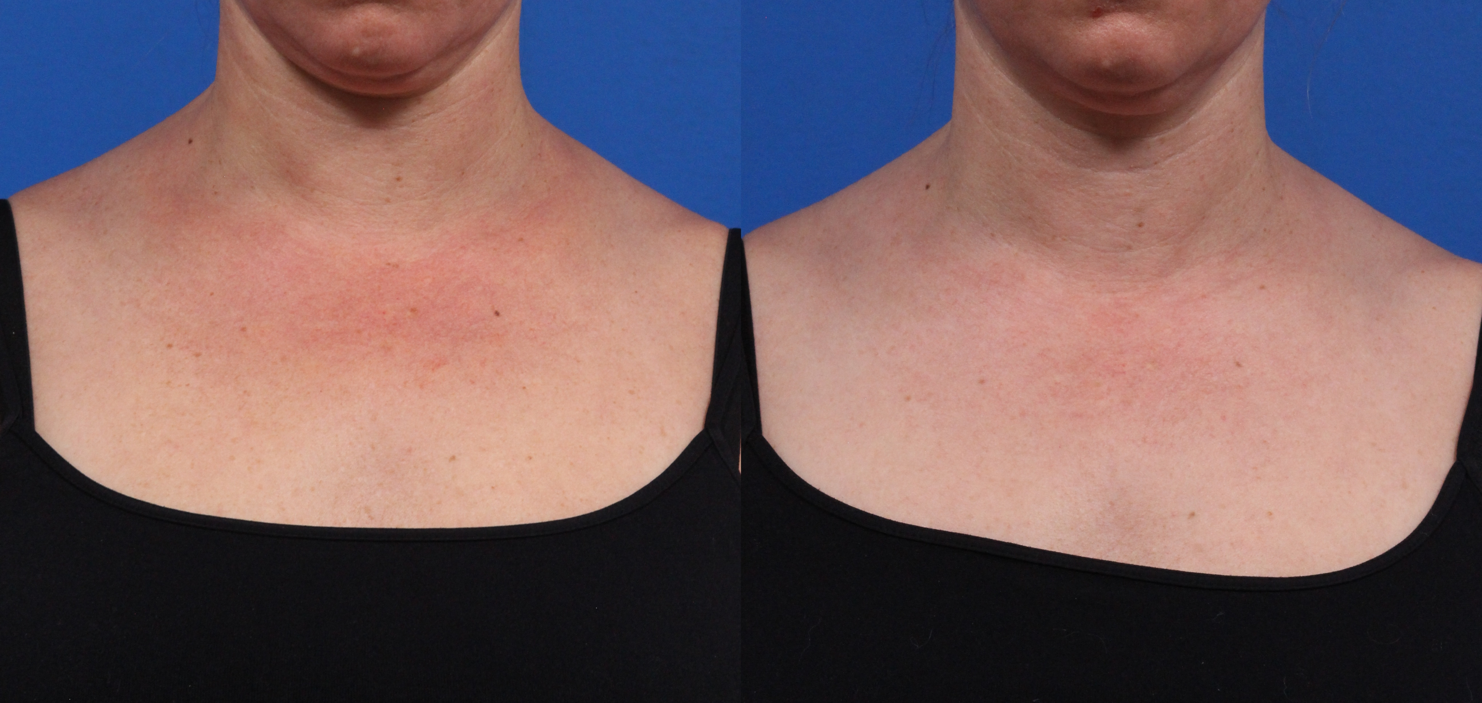 BBL Hero Gallery Before & After Gallery - Patient 144487879 - Image 1