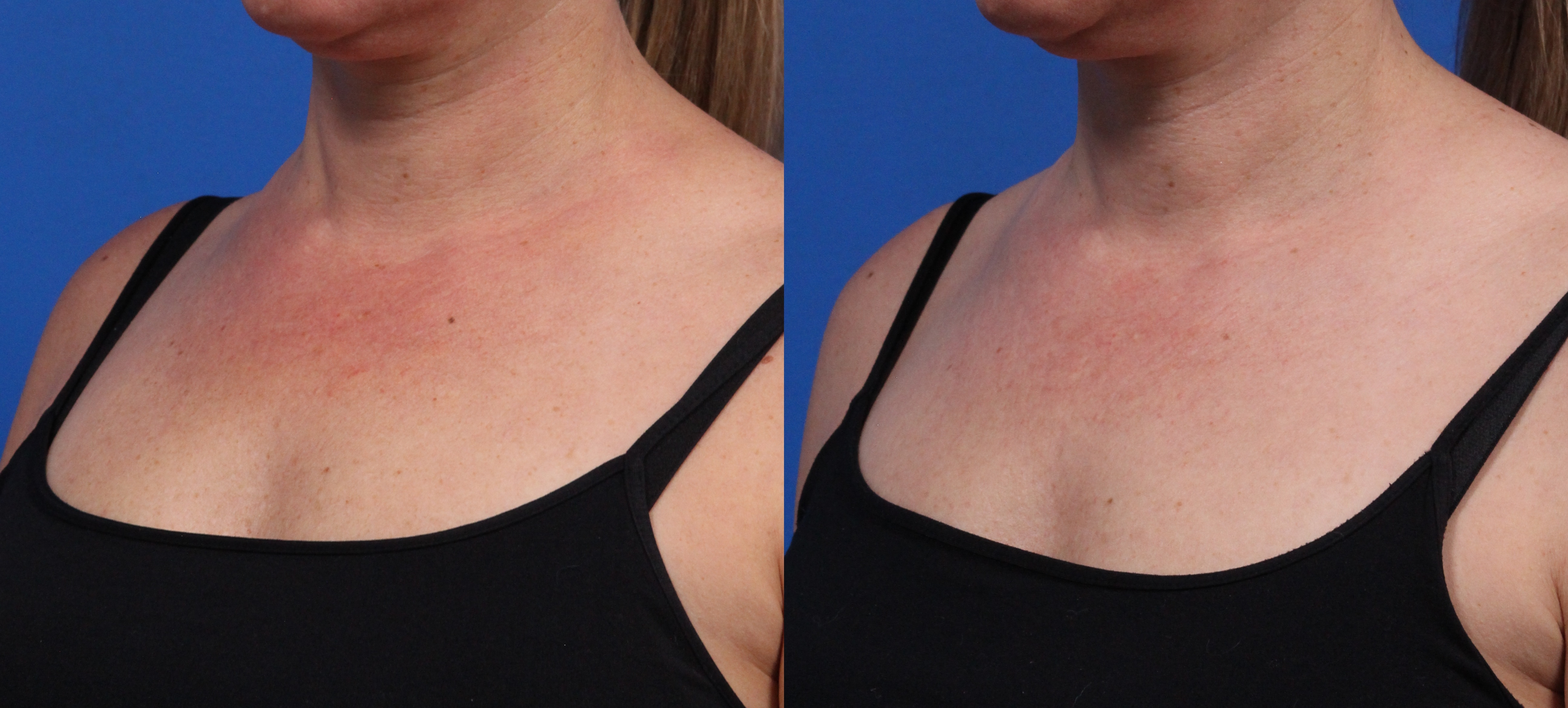 BBL Hero Gallery Before & After Gallery - Patient 144487879 - Image 3