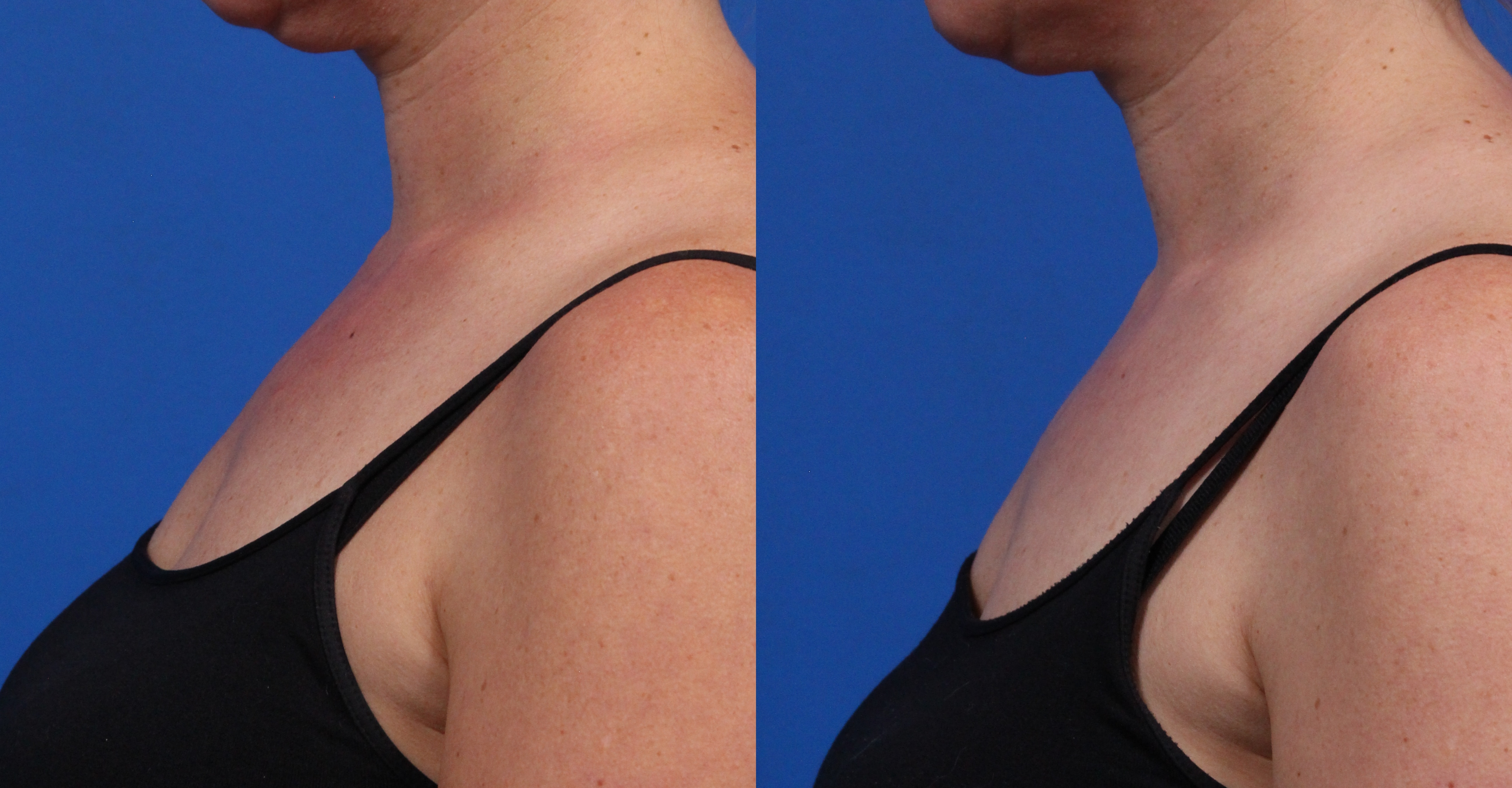 BBL Hero Gallery Before & After Gallery - Patient 144487879 - Image 4