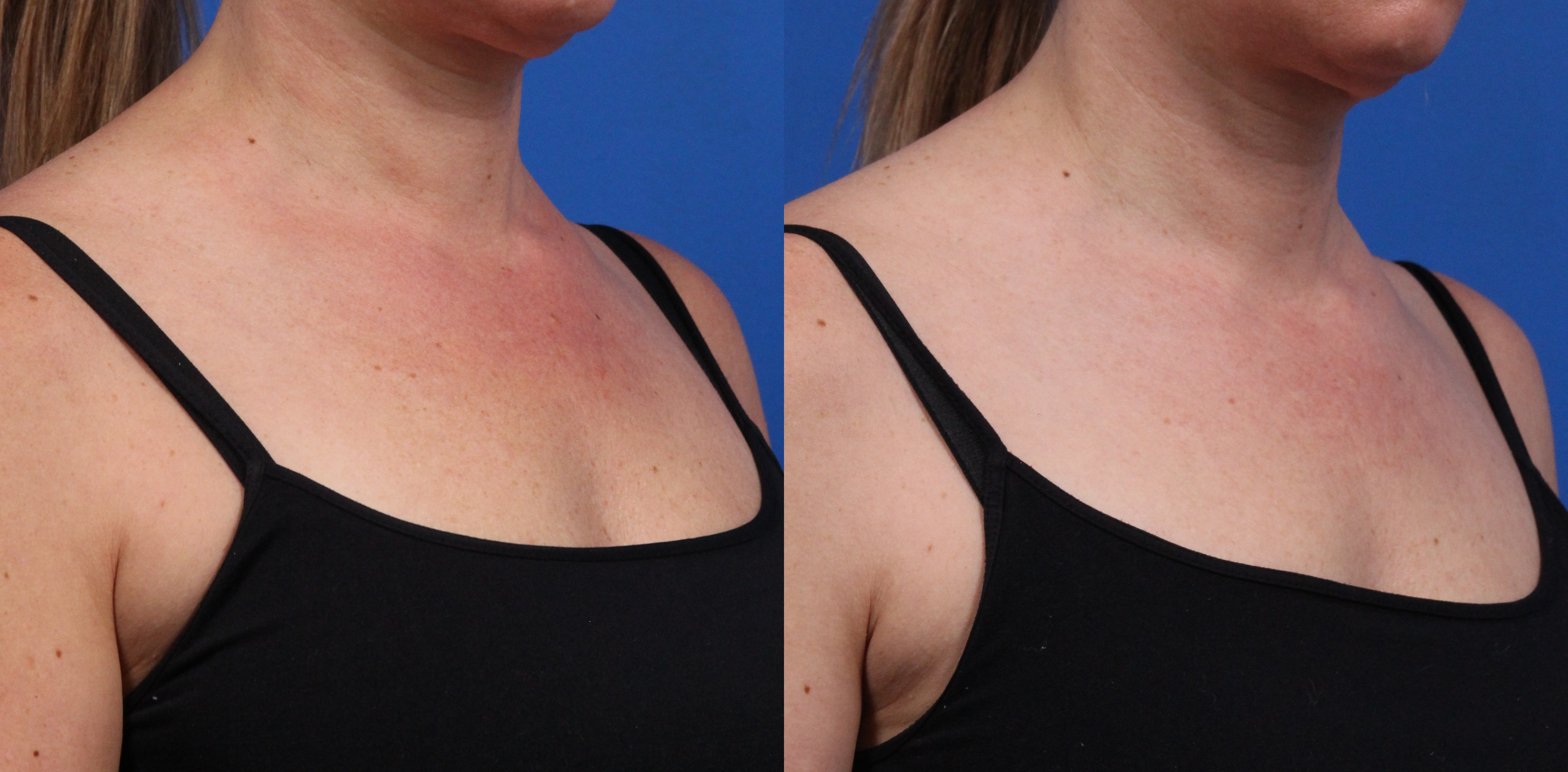 BBL Hero Gallery Before & After Gallery - Patient 144487879 - Image 2