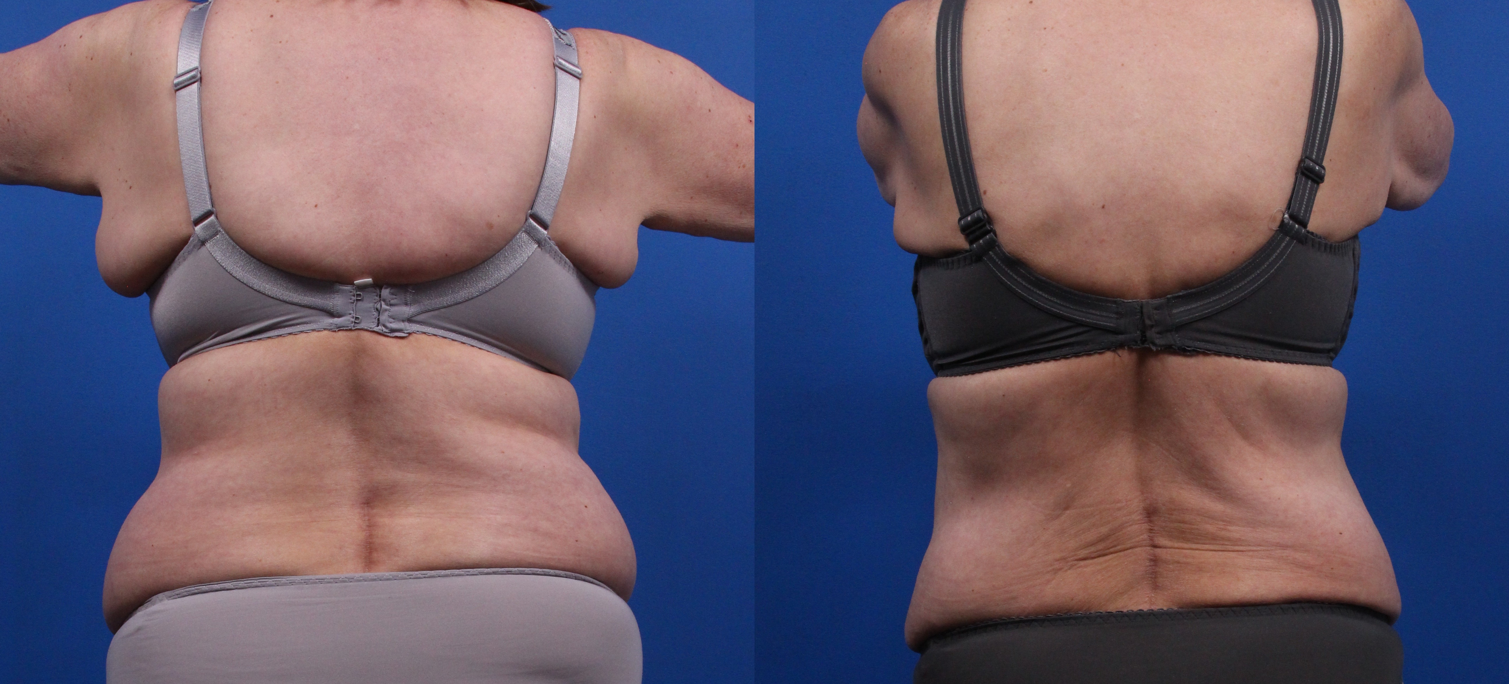 Semaglutide Weight Loss Before & After Gallery - Patient 495103 - Image 1